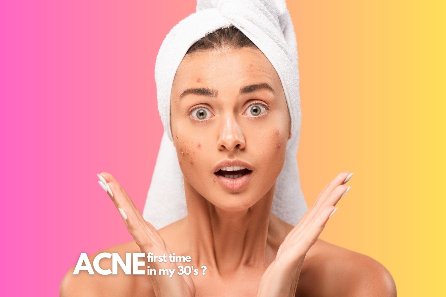 Adult acne: Getting acne for first time in my 30’s