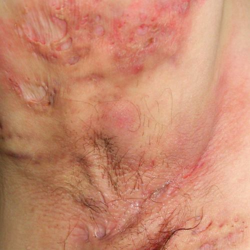 Hidradenitis suppurativa