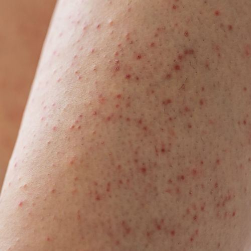 Keratosis Pilaris - Dr. Hinah Altaf