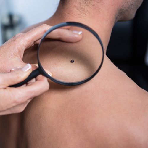 Melanoma Screening