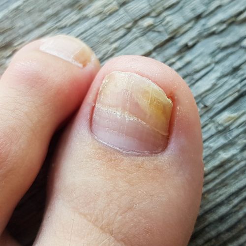 Nail Fungus