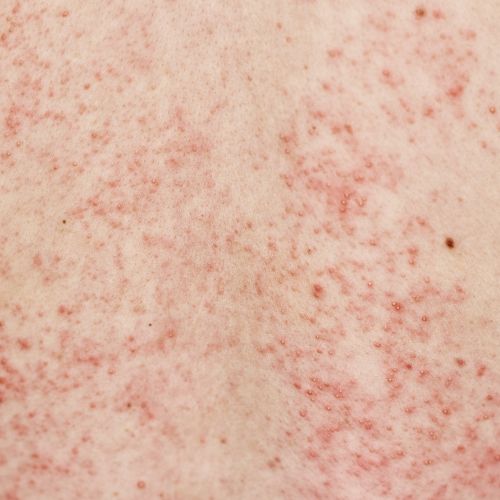 Skin Rash - Dr. Hinah Altaf