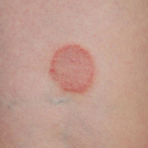 Ringworm - Dr. Hinah Altaf