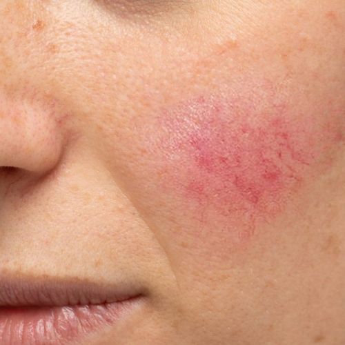 Rosacea Treatment