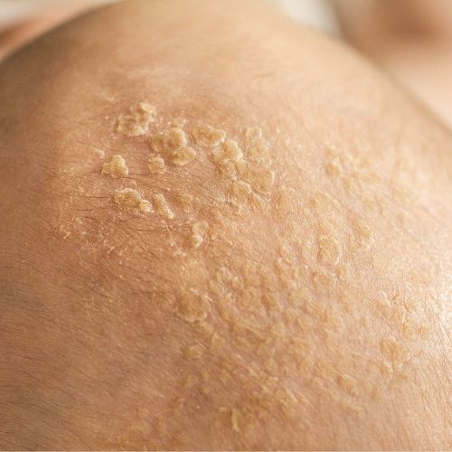 seborrheic dermatitis treatment