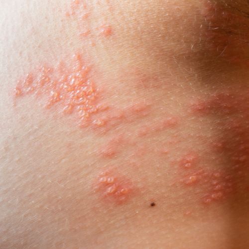 shingles image