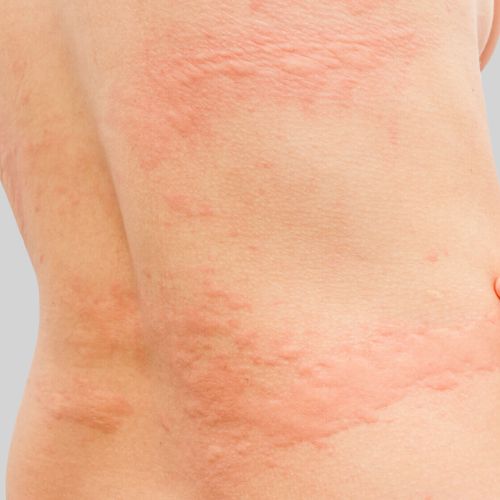 Urticaria (Hives) - Dr. Hinah Altaf