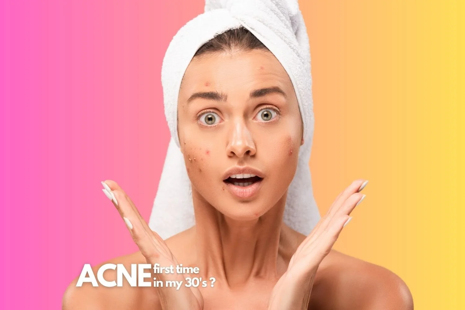 Adult acne